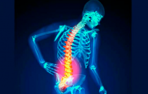 Osteoporose: definição, causas e tratamento