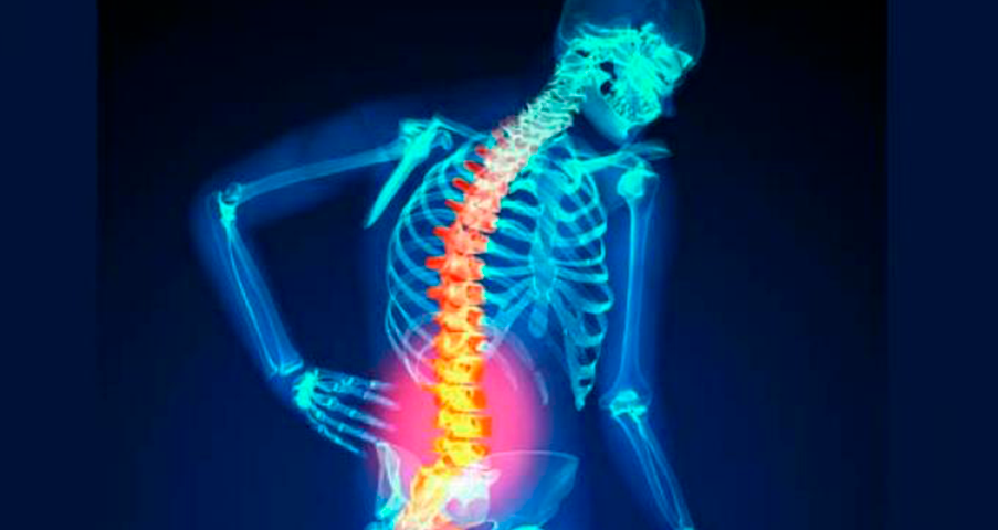 Osteoporose: definição, causas e tratamento